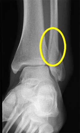 Broken-Ankle-Symptoms.jpg